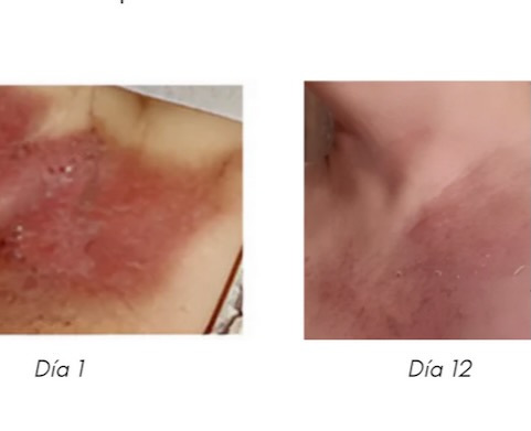 Tratamiento quemaduras radioterapia