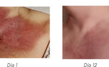 Tratamiento quemaduras radioterapia