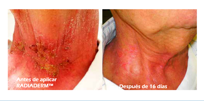 radiaderm efectos radioterapia crema